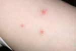 What Are The Symptoms Of Bed Bug Bites?
